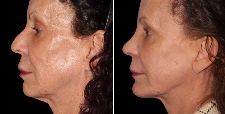 Before & After Nose Surgery Alpharetta GA