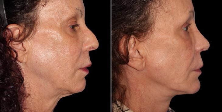 Nose Surgery Before & After Alpharetta GA