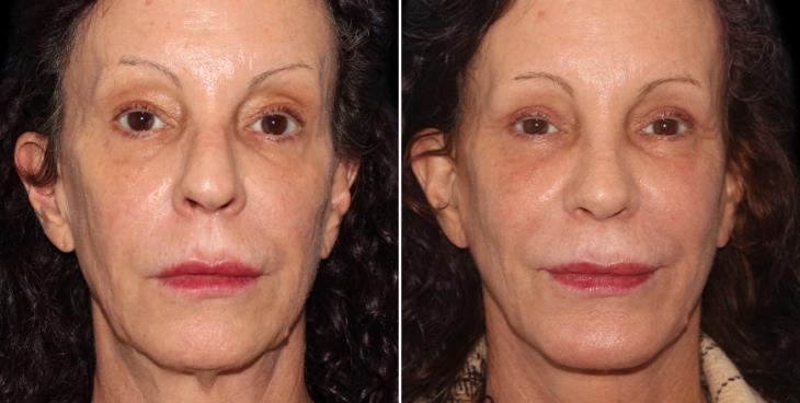 Results Of Chin Augmentation In Atlanta