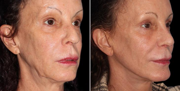 Before & After Chin Augmentation In Atlanta ¾ Right View