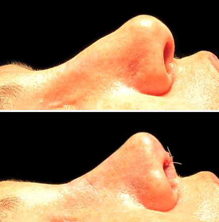 Results Of Rhinoplasty Surgery Alpharetta