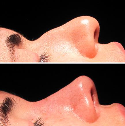 Alpharetta Results Of Rhinoplasty Surgery