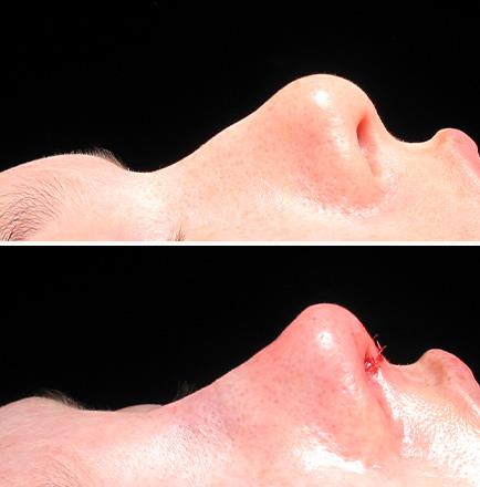 Results Of Rhinoplasty Alpharetta Georgia