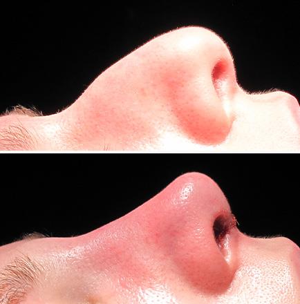 Before & After Rhinoplasty Alpharetta Georgia