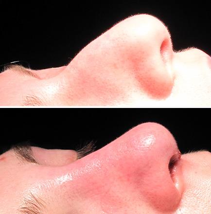 Before And After Rhinoplasty Alpharetta Georgia