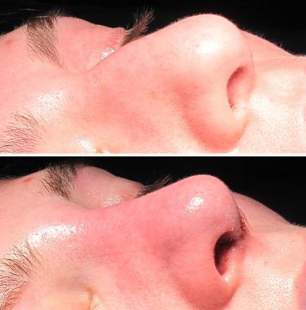 Rhinoplasty Before & After Alpharetta Georgia