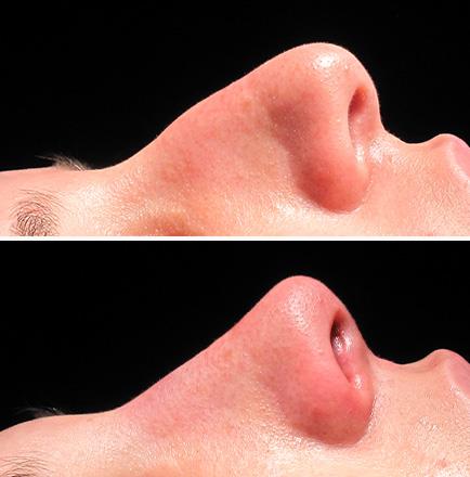 Before & After Rhinoplasty Surgery Alpharetta Georgia