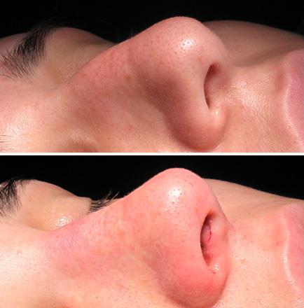 Rhinoplasty Surgery Before & After Alpharetta Georgia
