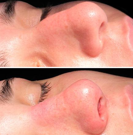 Rhinoplasty Surgery Before And After Alpharetta Georgia