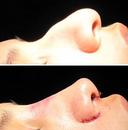 Nose Surgery Results Alpharetta Georgia