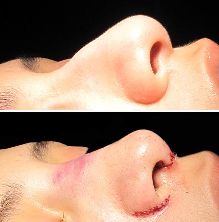 Results Of Nose Surgery Alpharetta Georgia