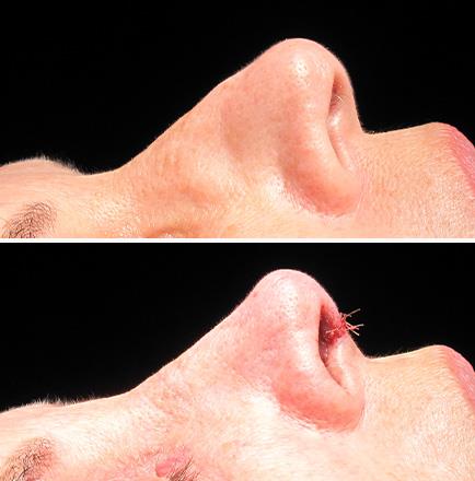 Before And After Nose Surgery Alpharetta Georgia