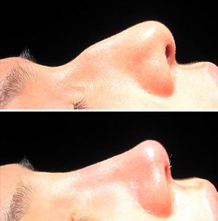 Results Of Rhinoplasty In Atlanta