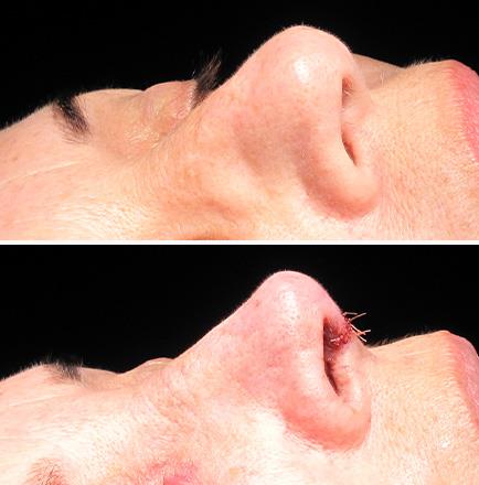 Nose Surgery Before And After Alpharetta Georgia