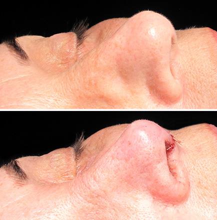 Before & After Nose Surgery Alpharetta Georgia