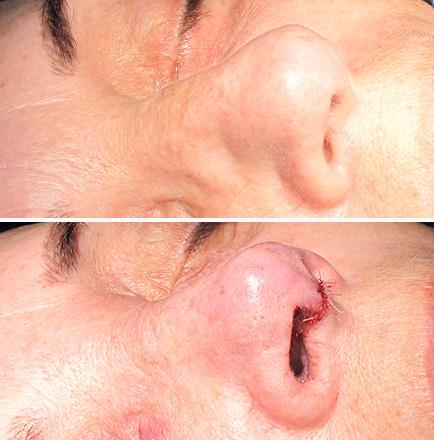 Rhinoplasty Results In Atlanta