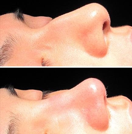 Rhinoplasty Surgery Results In Atlanta