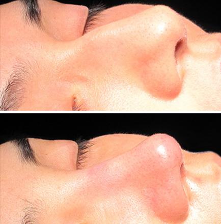 Results Of Rhinoplasty Surgery In Atlanta