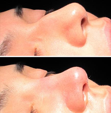 Before & After Rhinoplasty In Atlanta