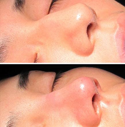 Before And After Rhinoplasty In Atlanta