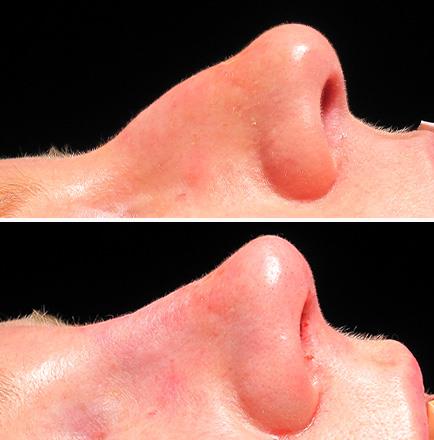 Rhinoplasty Before & After In Atlanta