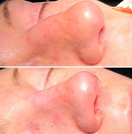 Rhinoplasty Before And After In Atlanta