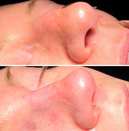 Before & After Rhinoplasty Surgery In Atlanta