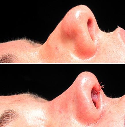 Before And After Rhinoplasty Surgery In Atlanta