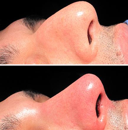 Nose Surgery Results In Atlanta