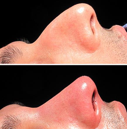 Nose Surgery Results In Atlanta