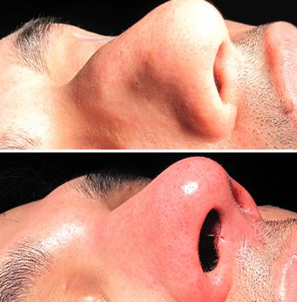 Before And After Nose Surgery In Atlanta