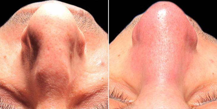 Nose Surgery Before And After In Atlanta