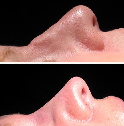 Before & After Nose Surgery In Atlanta