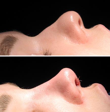 Before & After Rhinoplasty In Atlanta GA