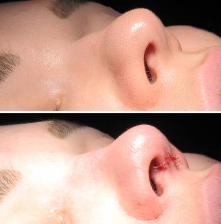 Rhinoplasty Before And After In Atlanta GA