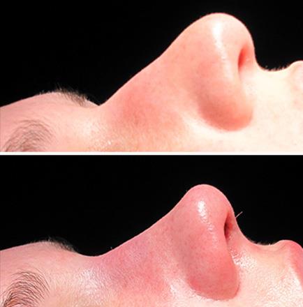 Before & After Rhinoplasty Surgery In Atlanta GA