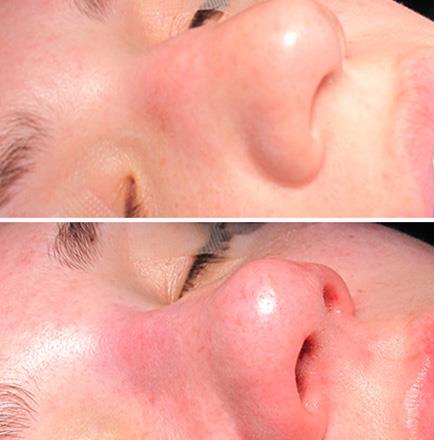 Before And After Rhinoplasty Surgery In Atlanta GA