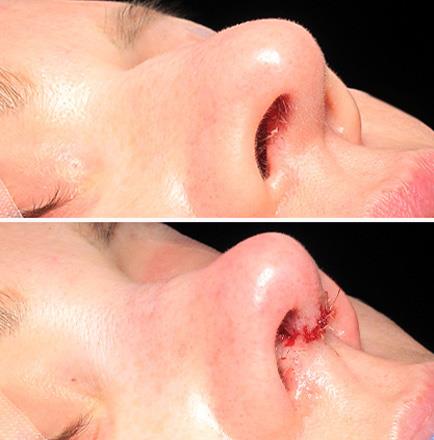 Rhinoplasty Surgery Before And After In Atlanta GA