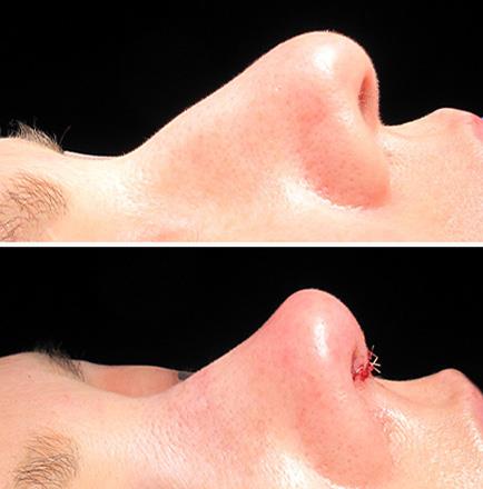 Nose Surgery Results In Atlanta GA