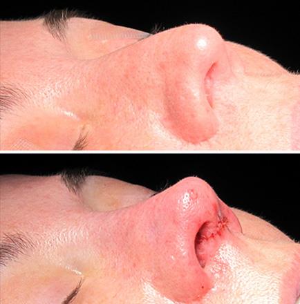 Results Of Nose Surgery In Atlanta GA