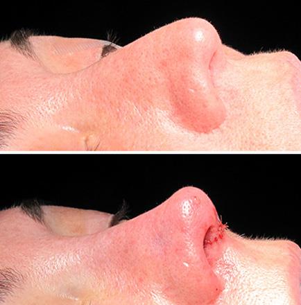 Before And After Nose Surgery In Atlanta GA