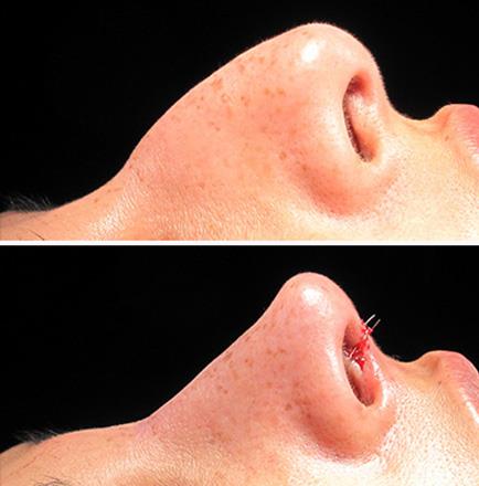 Before & After Nose Surgery In Atlanta GA