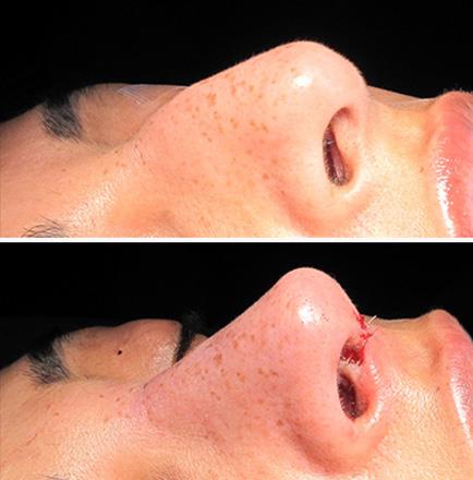 Nose Surgery Before & After In Atlanta GA