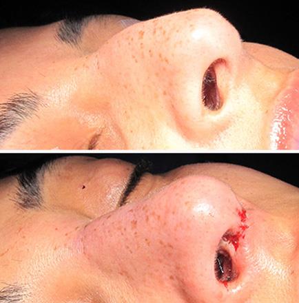 Rhinoplasty Results In Atlanta Georgia