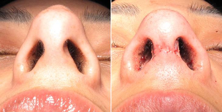 Results Of Rhinoplasty In Atlanta Georgia