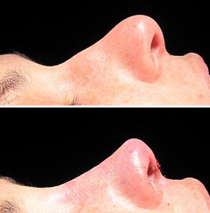 Rhinoplasty Surgery Results In Atlanta Georgia