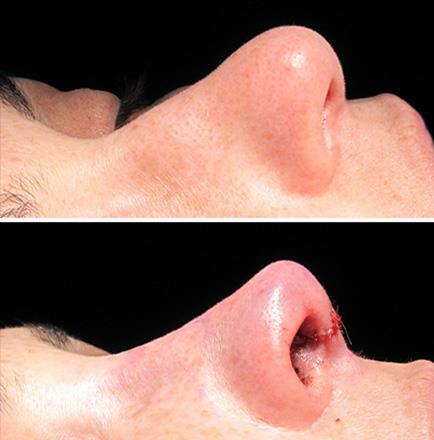 Results Of Rhinoplasty Surgery In Atlanta Georgia