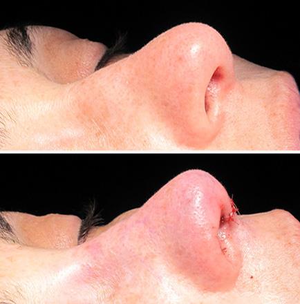Before & After Rhinoplasty In Atlanta Georgia