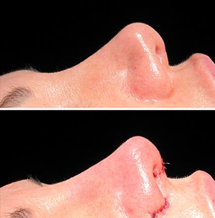 Before And After Rhinoplasty In Atlanta Georgia