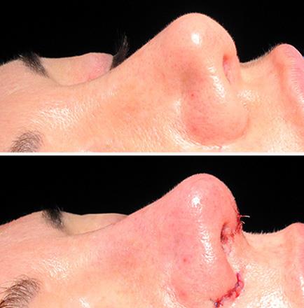 Rhinoplasty Before & After In Atlanta Georgia
